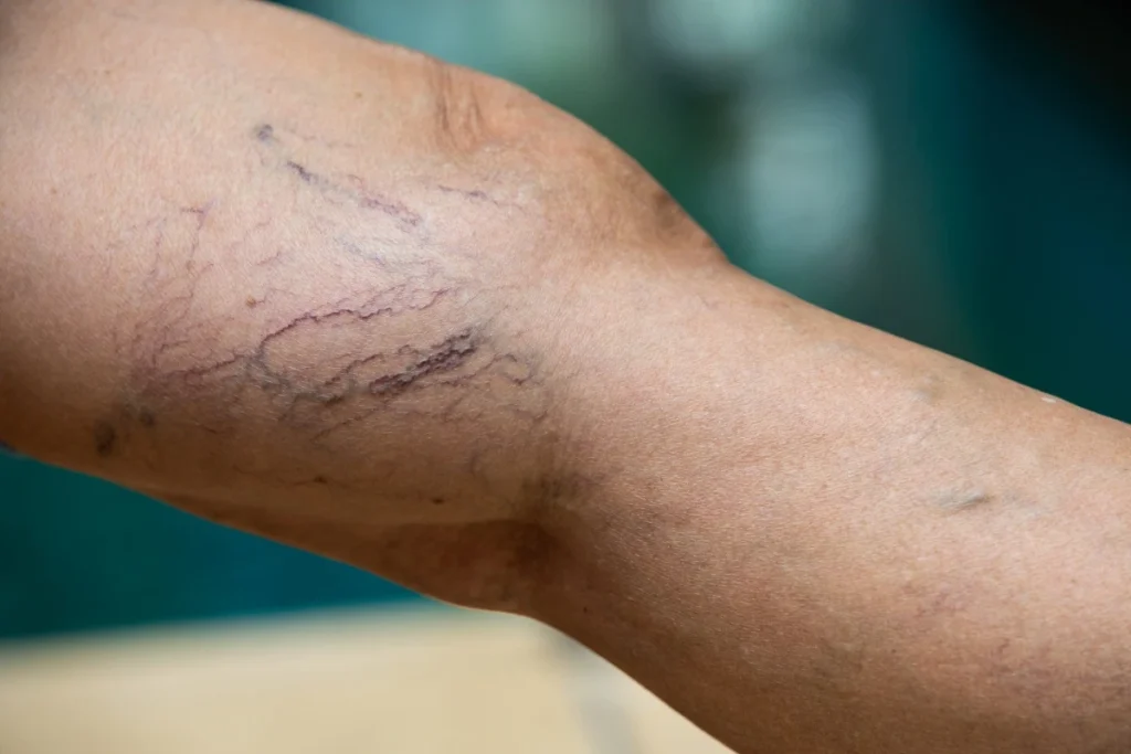 7 Things That May Be Causing Your Vein Condition