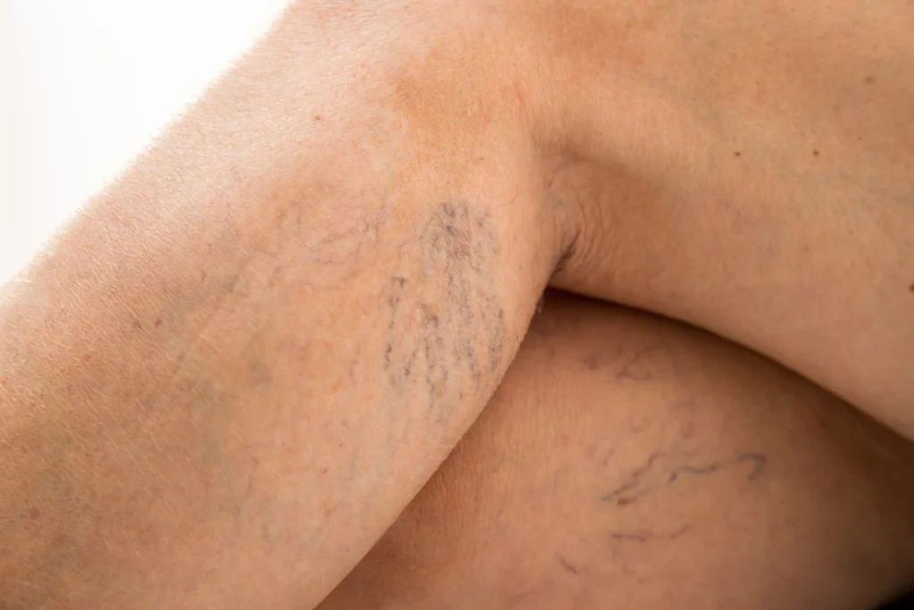 3 Common Vein Problems