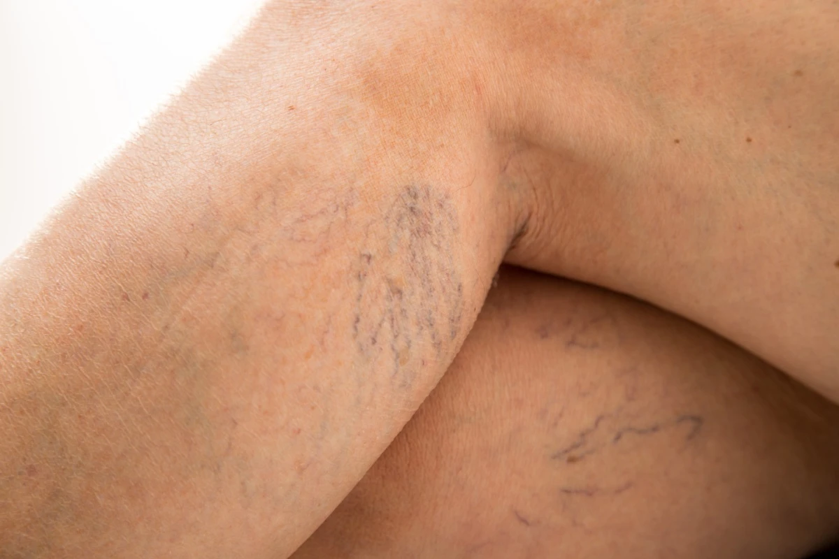 3 Common Vein Problems