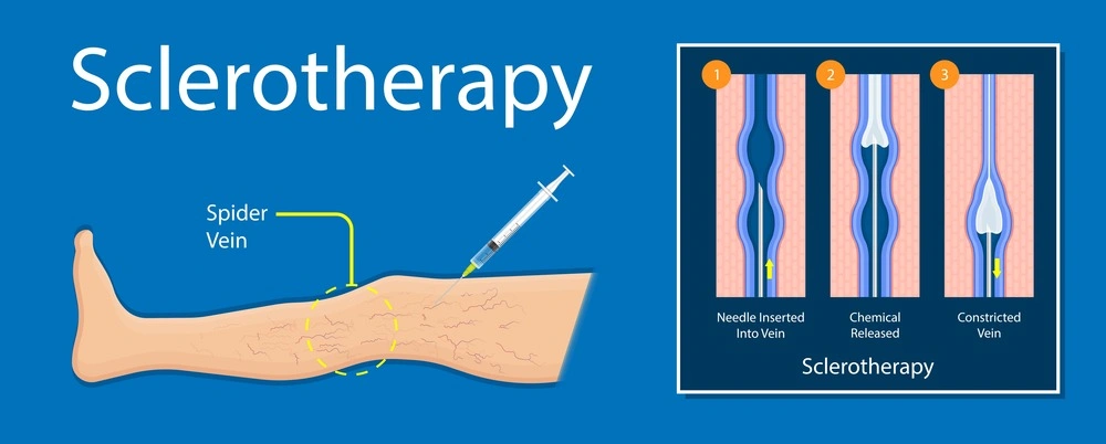 Sclerotherapy