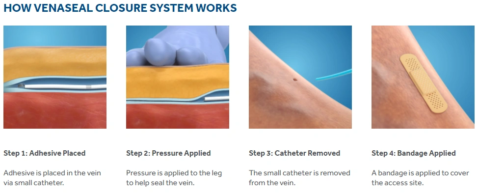 how Venaseal Closure System works
