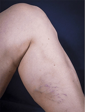 Sclerotherapy Before