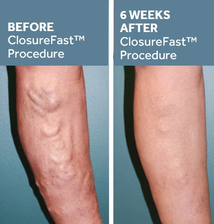 Before & After ClosureFast Procedure