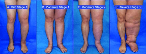 more stages of lymphatic buildup in legs