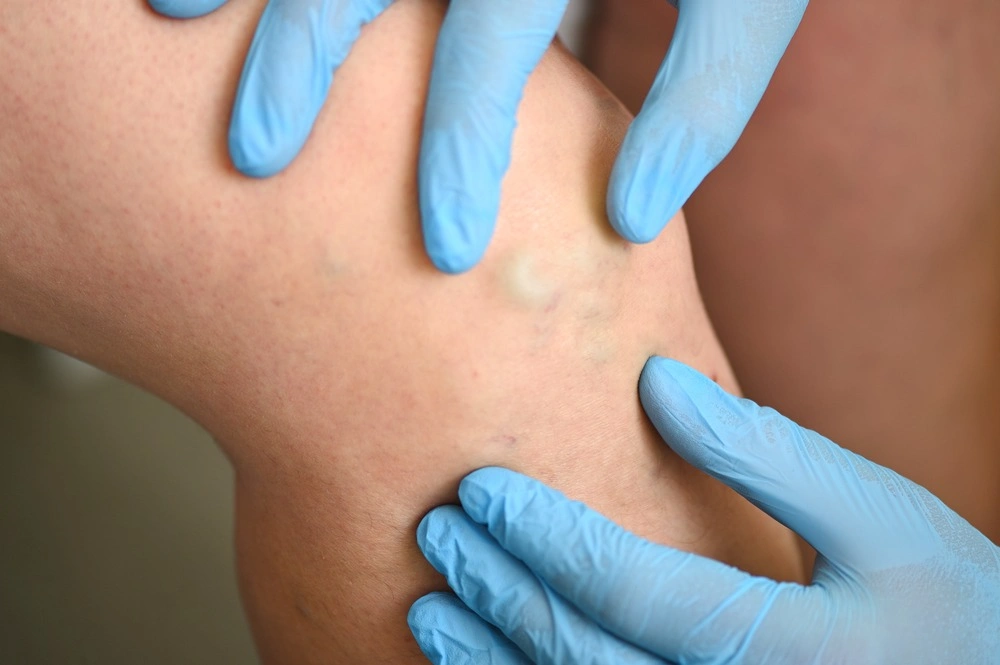 a phlebologist examines a patient with varicose veins on his leg