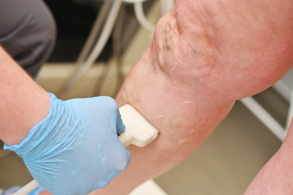 a phlebologist does an ultrasound of the veins of a patient with varicose veins.