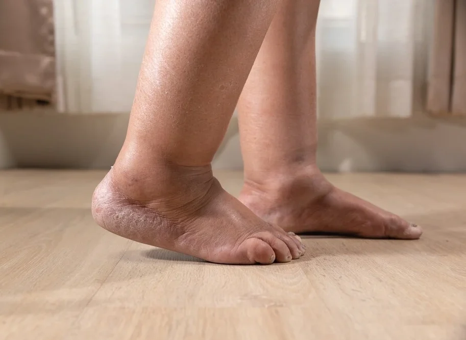 Woman's leg is edema (swelling) after cancer treatment.