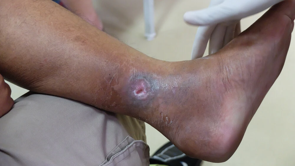 Venous ulcer or varicose ulcer at the medial side of leg.