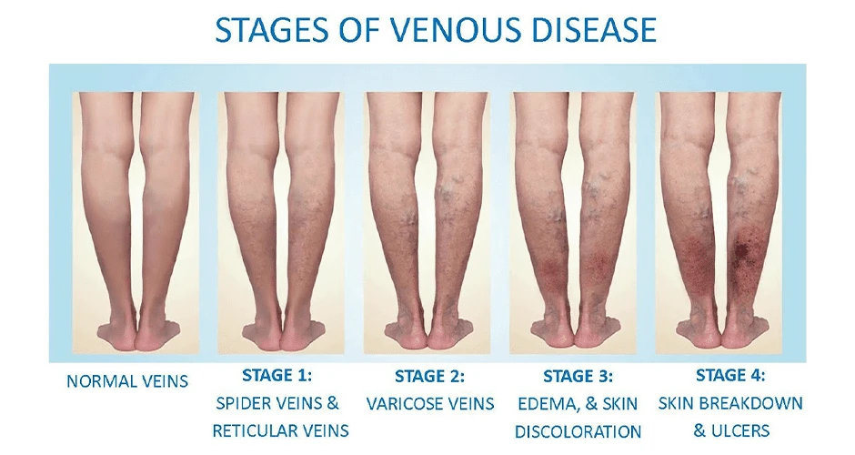 stages of venous disease