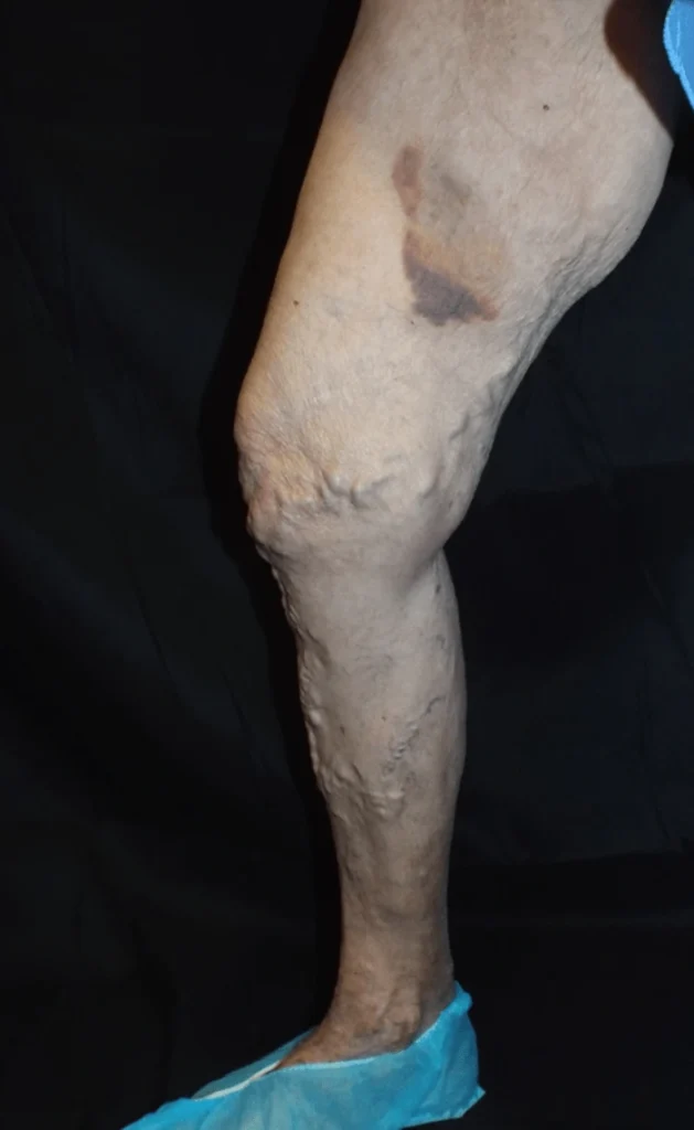 Barcellie Progression 1 Week