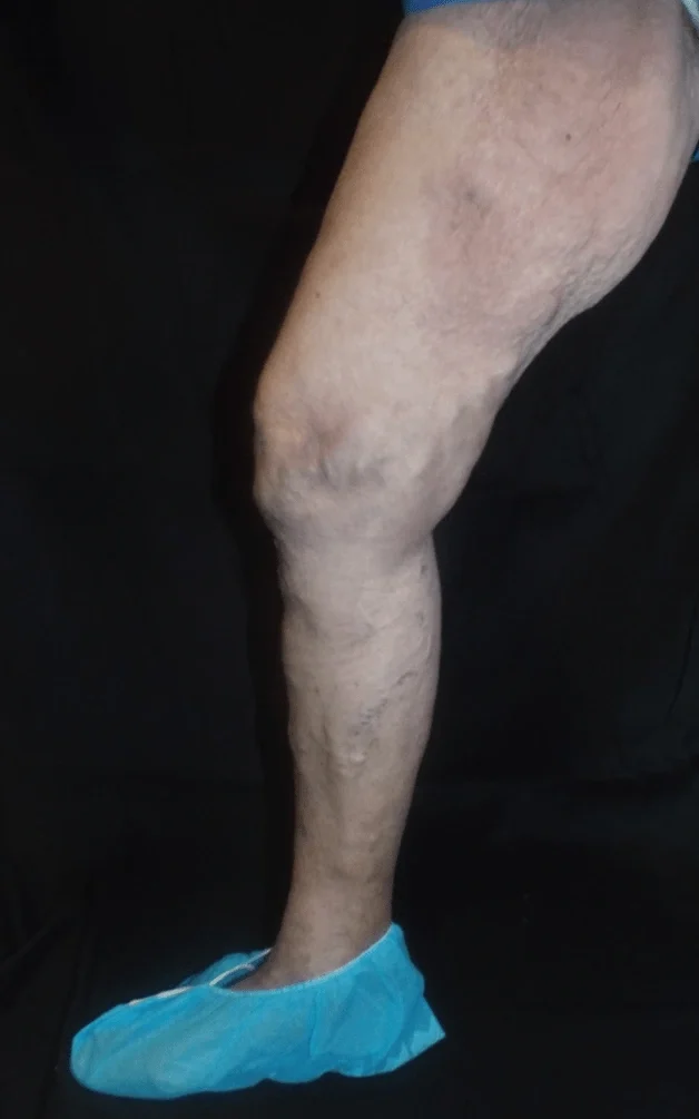 Barcellie Progression 2 months