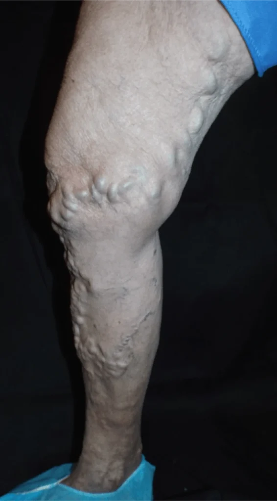 Barcellie Progression Before