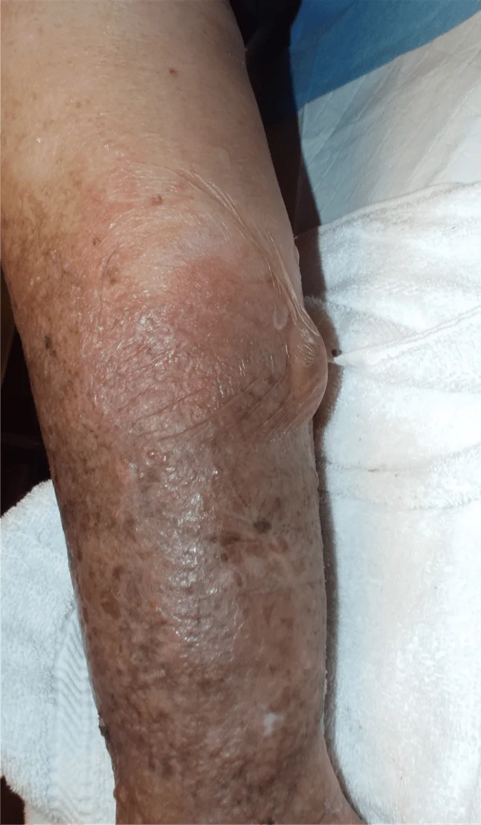 Lymph Blister Before