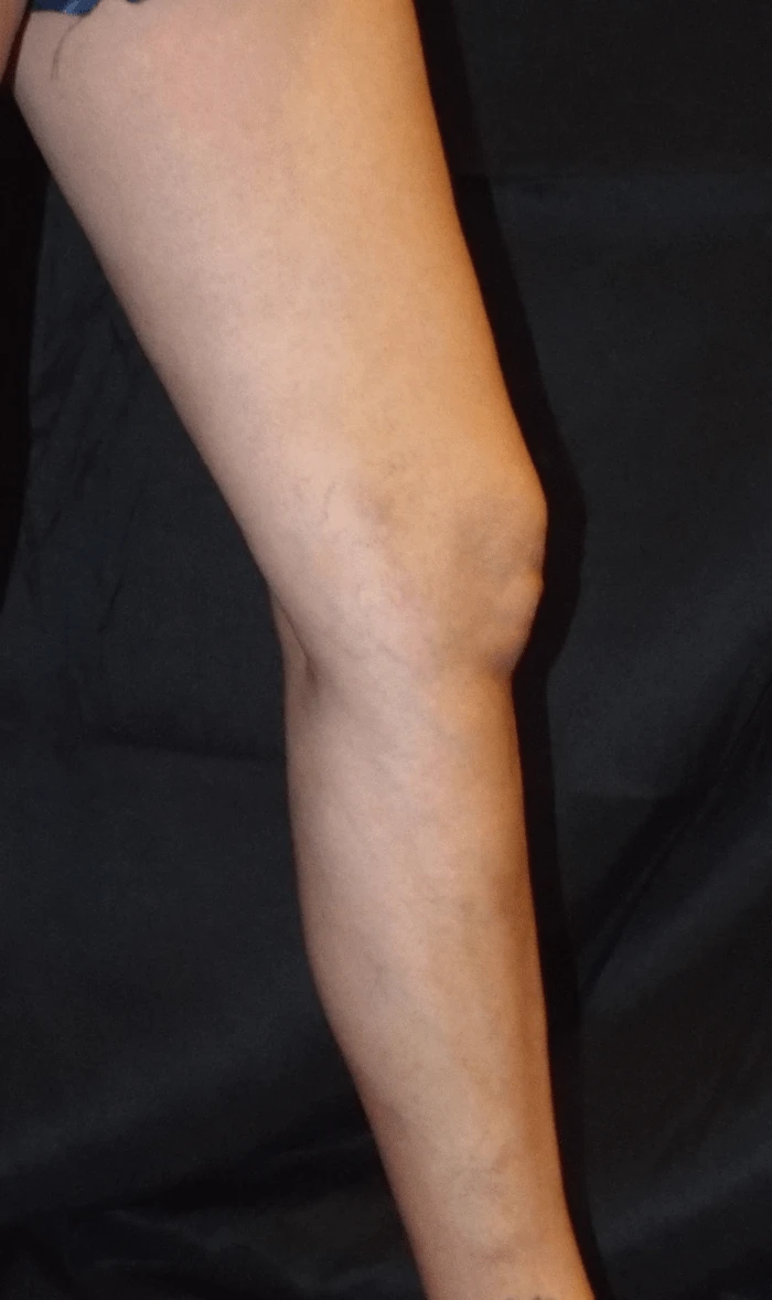 Trujillo Single Leg After