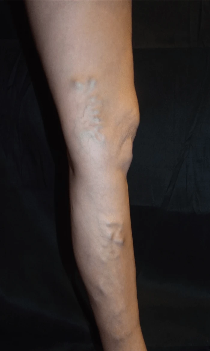 Trujillo Single Leg Before