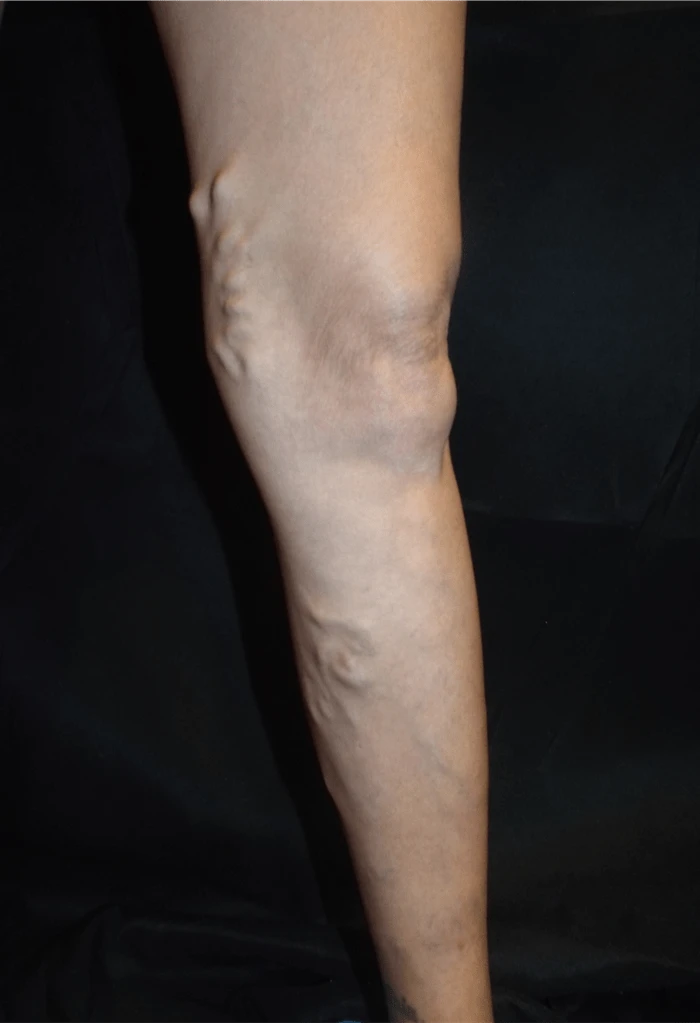 Trujillo Single Leg Before