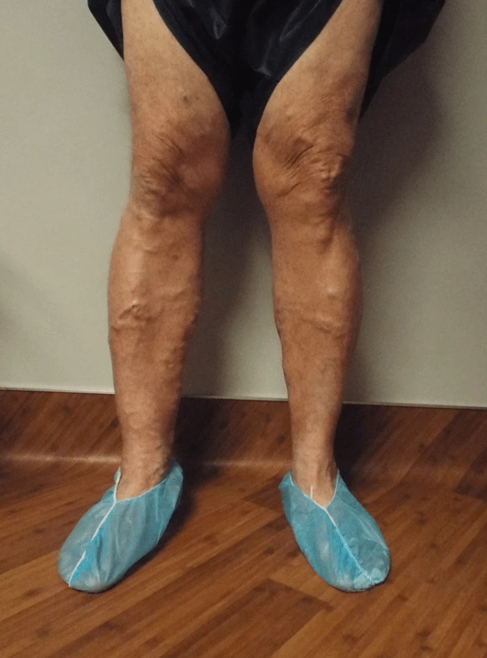 Wasserman BLE Before