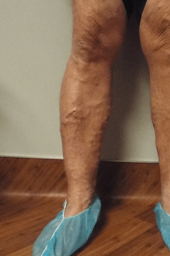 Wasserman RLE Before