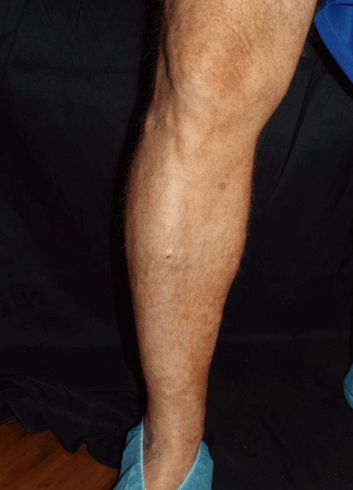 Wasserman RLE Front After