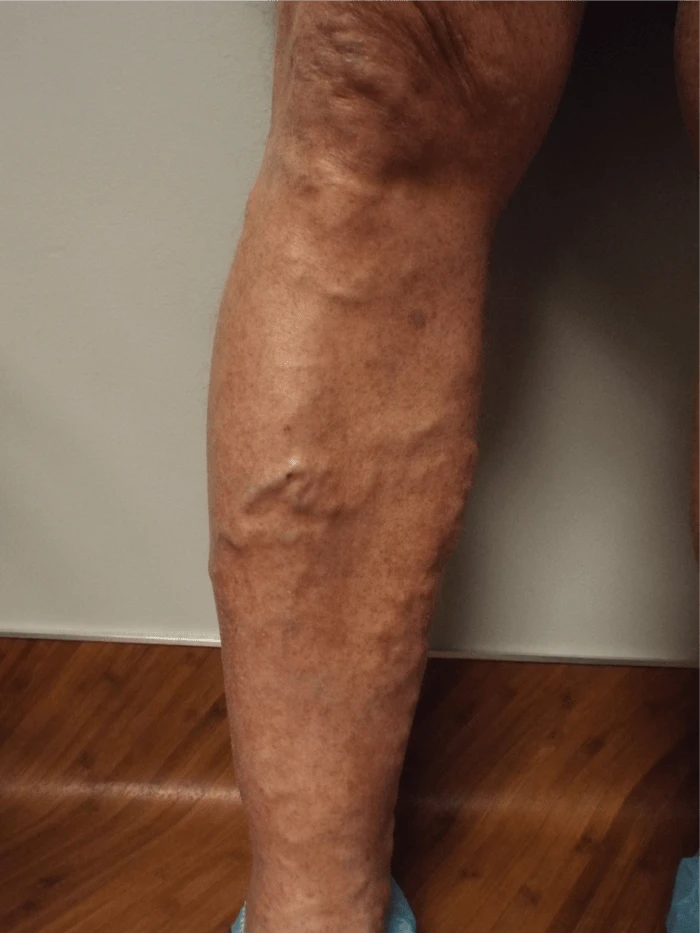 Wasserman RLE Front Before