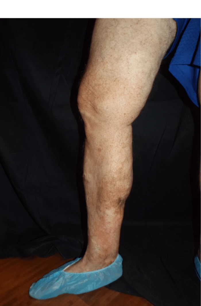 Wasserman RLE Medial View After