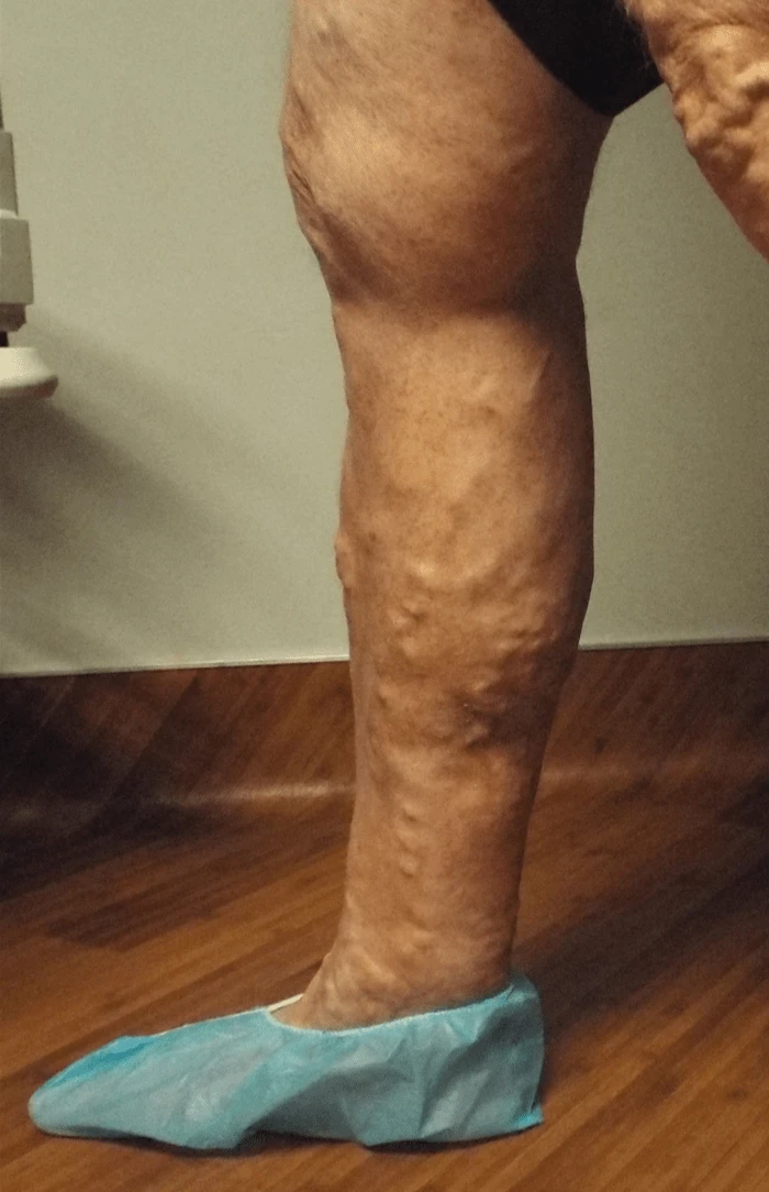 Wasserman RLE Medial View Before