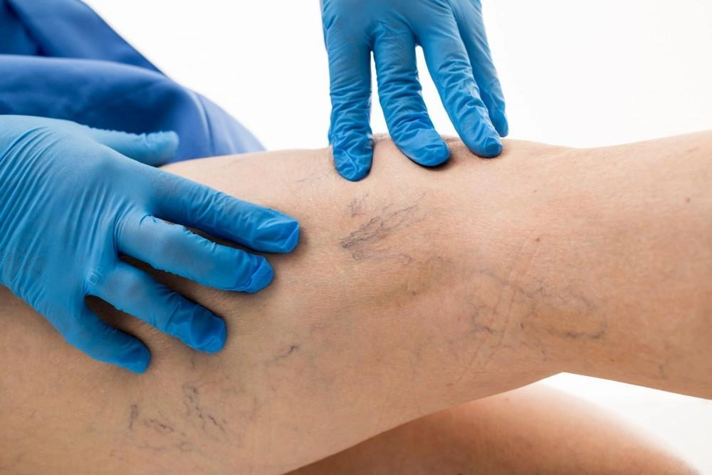 Blog: Are Varicose Veins Dangerous?