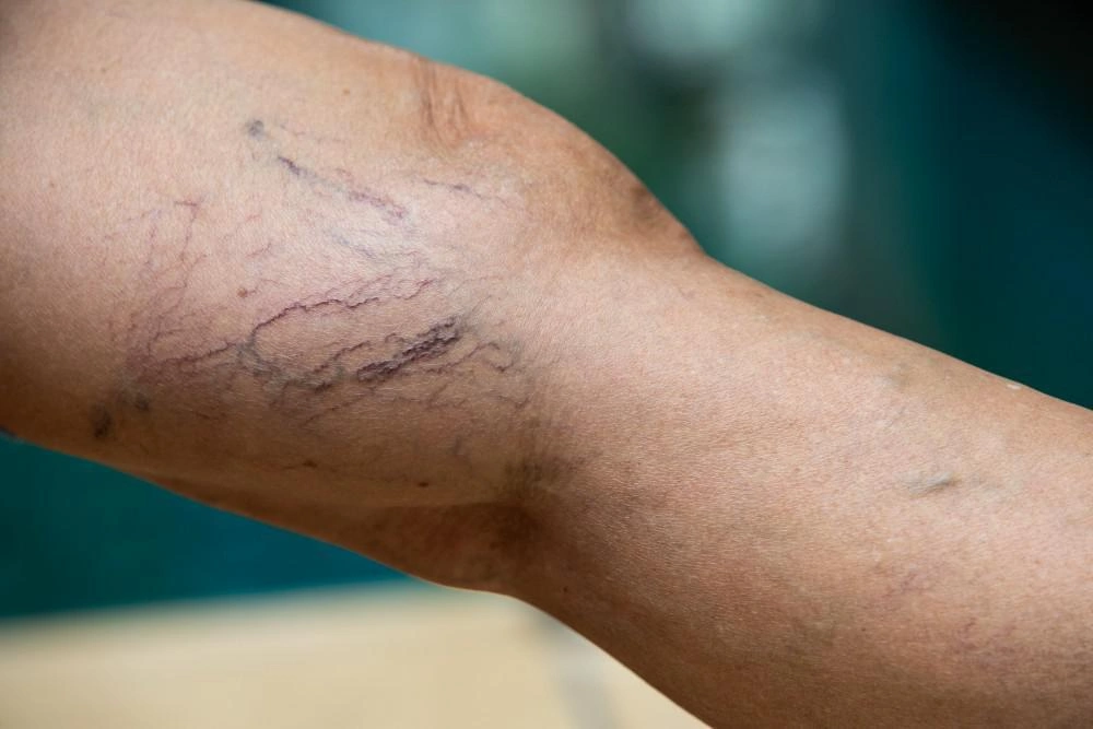 Blog: 7 Things That May Be Causing Your Vein Condition