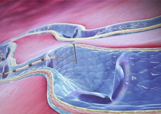 Clarivein: Non-Thermal Ablation