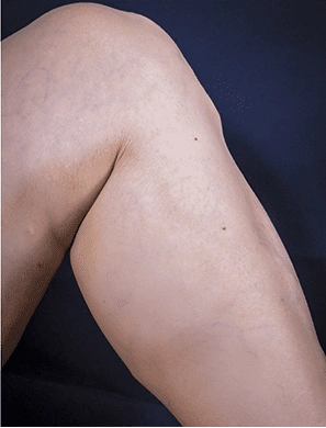 Sclerotherapy After