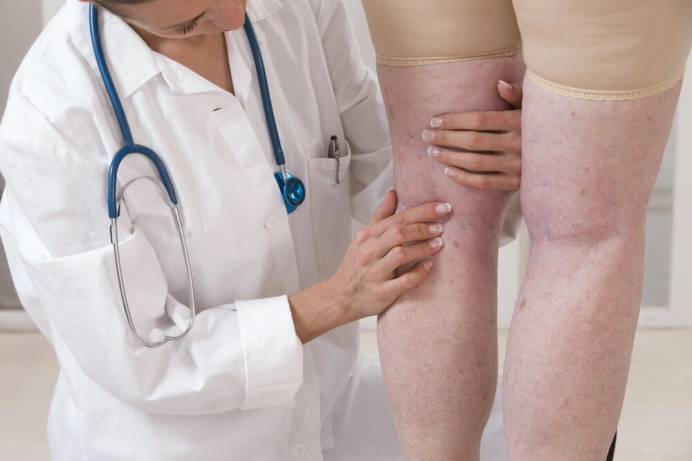 doctor showing varicose veins from an elderly woman